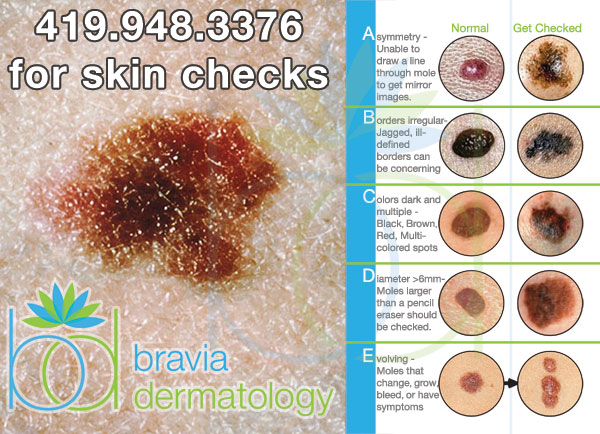 If you have any moles that meet the ABCD's of Melanoma, get checked right away.