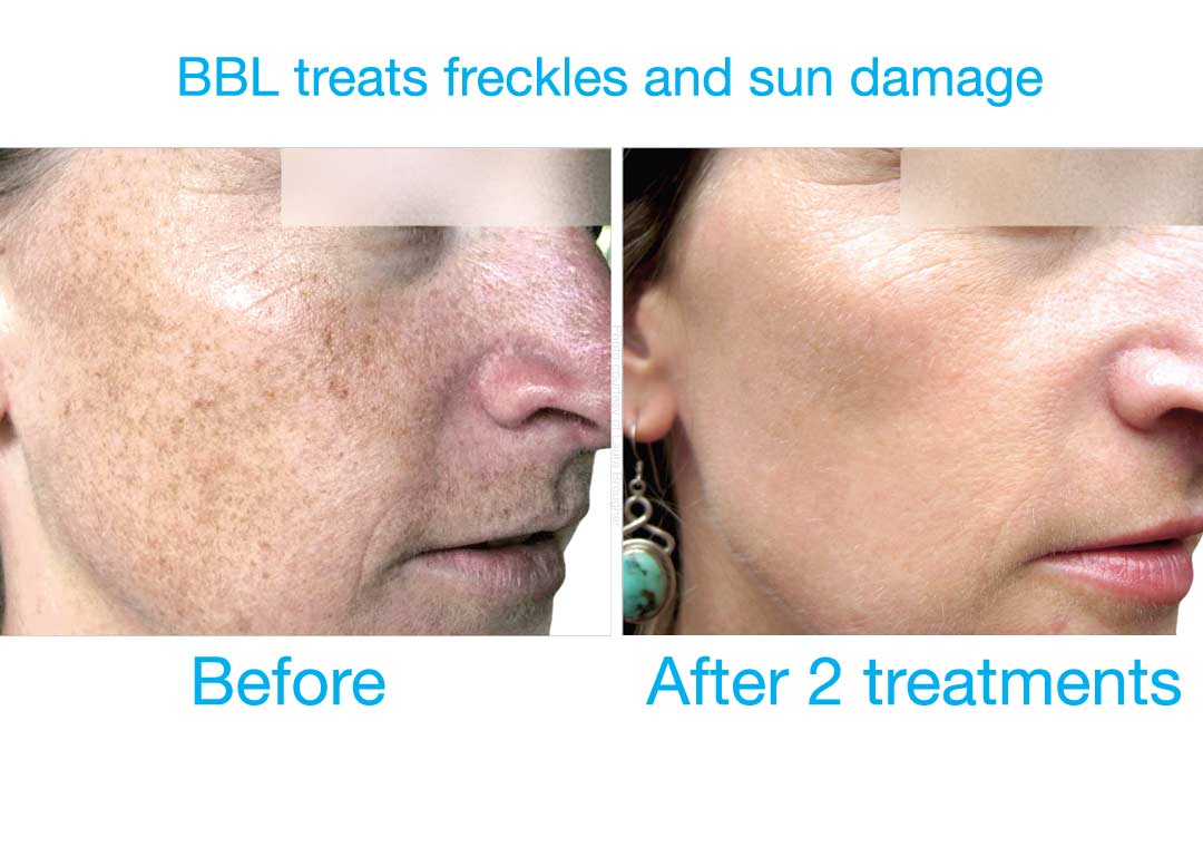 BBL at Bravia Dermatology treats freckles and sun damage very effectively.