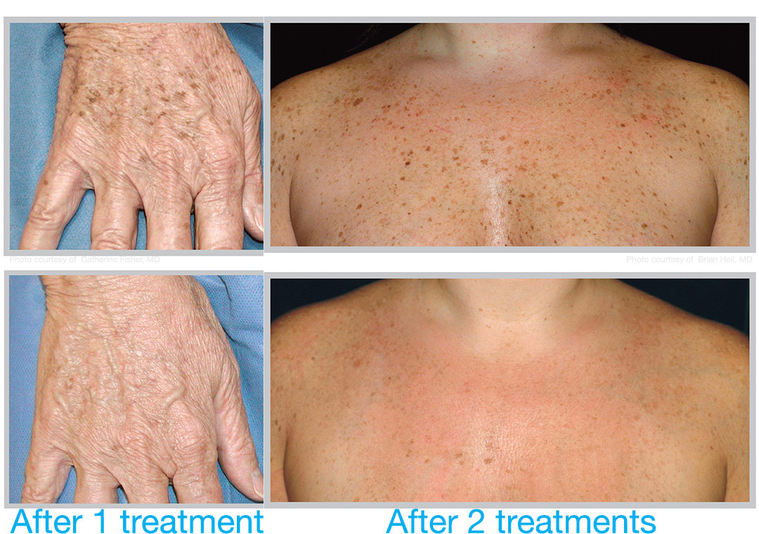 BBL corrects sun damage and dyspigmentation on hands and body. Bravia Dermatology offers BBL