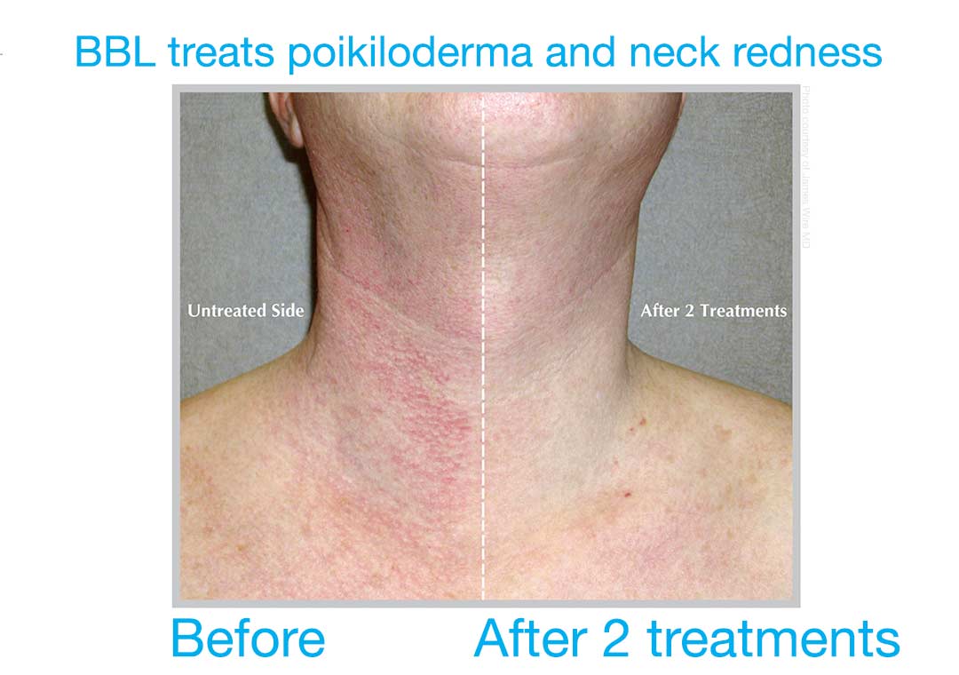 Neck redness and sun damage (Poikiloderma) can be successfully treated with BBL