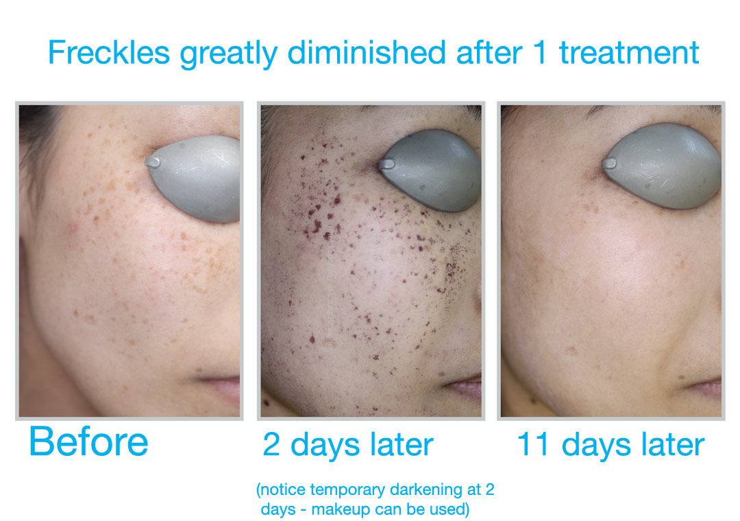 Sun damage and freckles can be treated with BBL at Bravia Dermatology