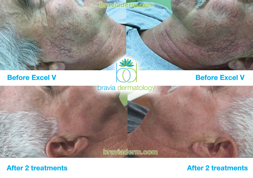 Excel V at Bravia Dermatology works great for cheek veins and telangiectasias