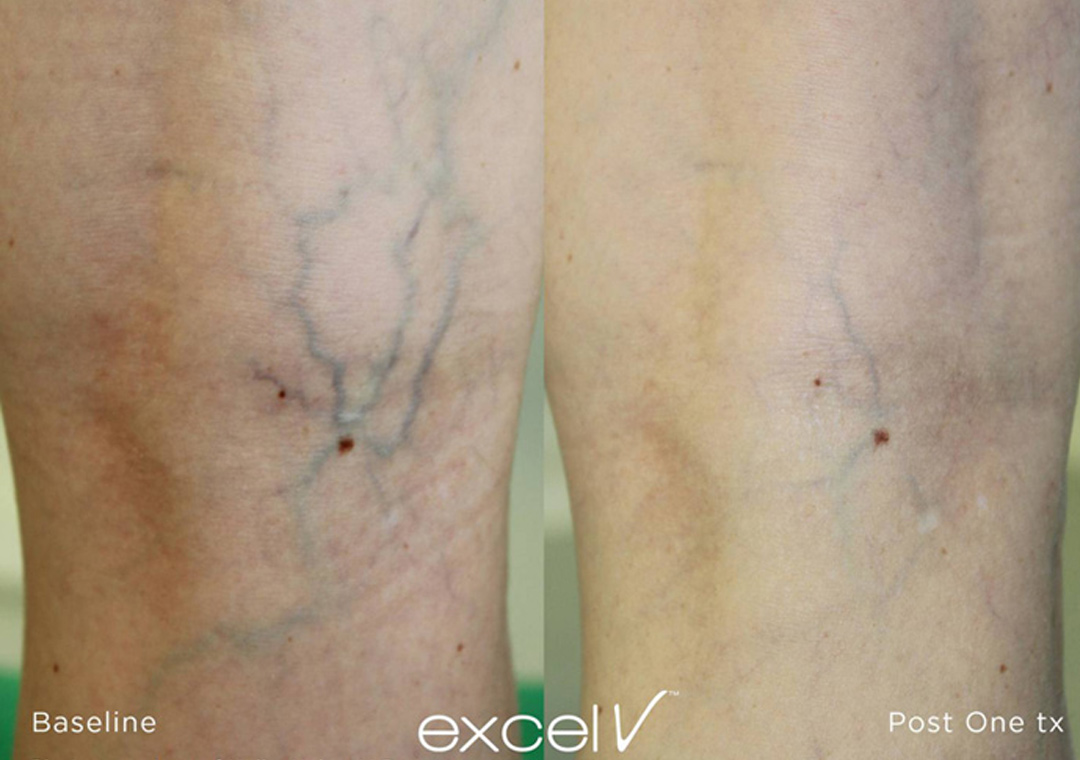 Leg veins can be diminished with Excel V