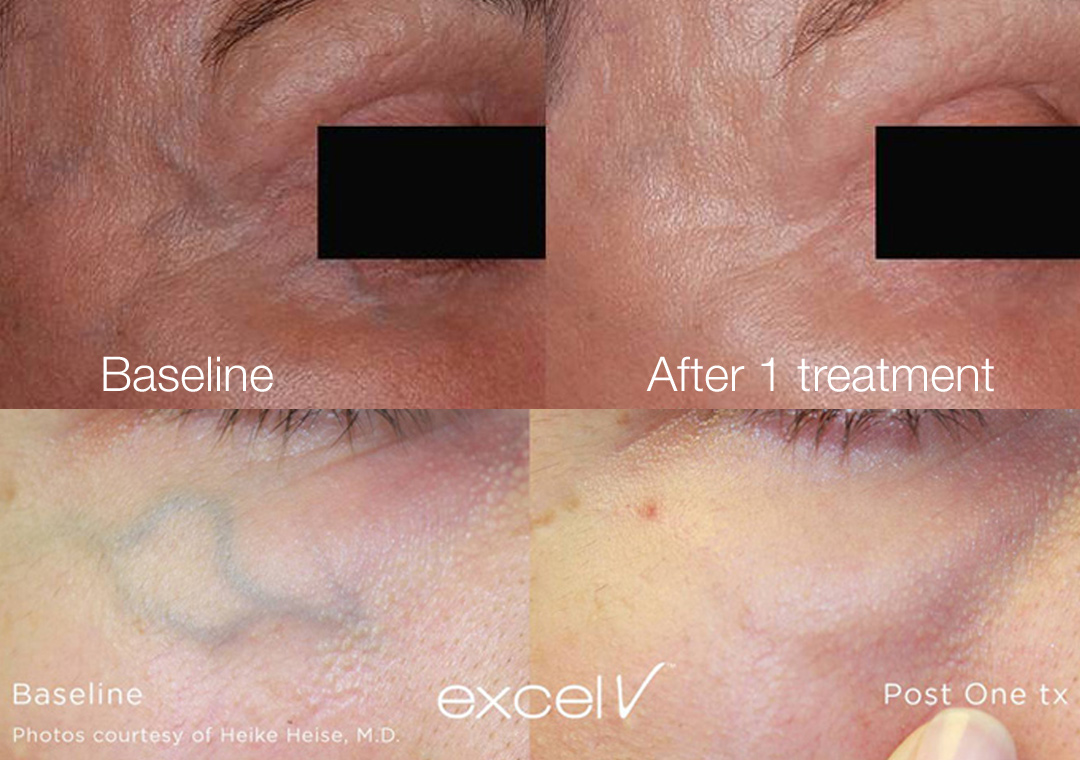 Periorbital veins, or veins around the eyes, disappear with Excel V