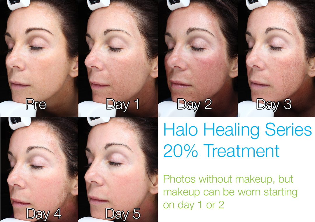 Halo at 20% - This demonstrates a medium treatment with very little swelling, and no oozing. Makeup can be worn the next day. Progress continues to occur for several months after treatment.