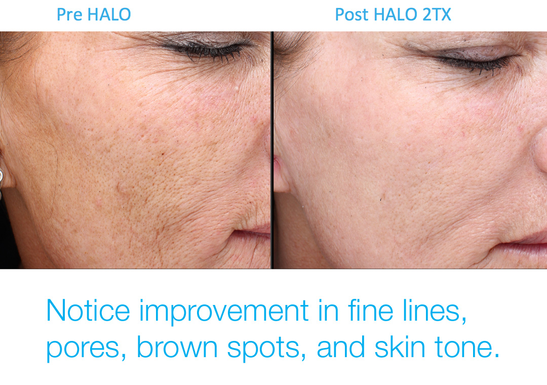 Halo improves fine lines, skin texture, pores, brown spots.