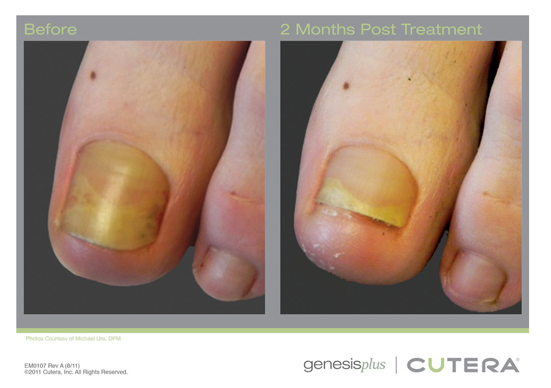 Laser Genesis treats nail fungus. Plan on at least 3 treatments.  The nail will slowly grow out.
