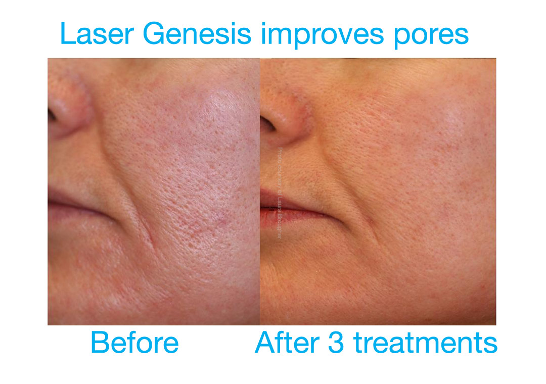 Laser Genesis improves pores and skin texture without downtime.