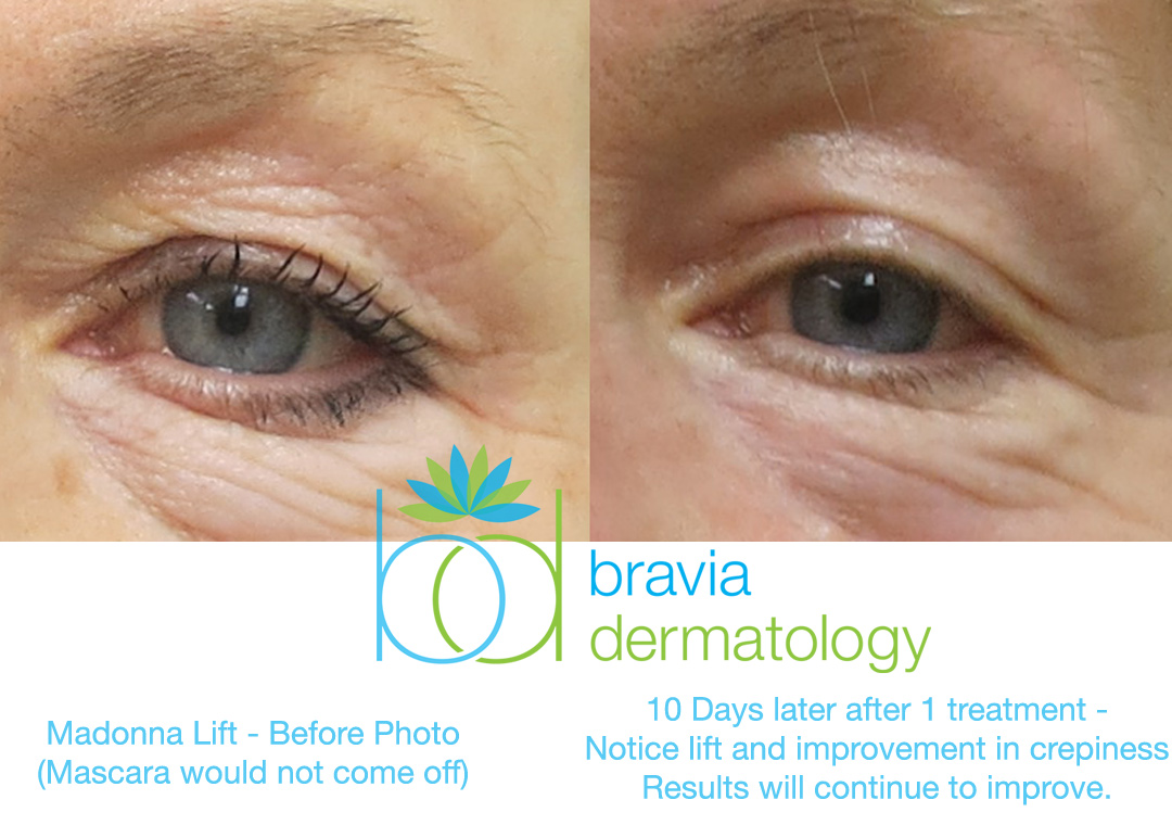 Madonna Lift at Bravia Dermatology for non-surgical improvement of sagging eyelid skin.  Notice the improvement of crepiness.