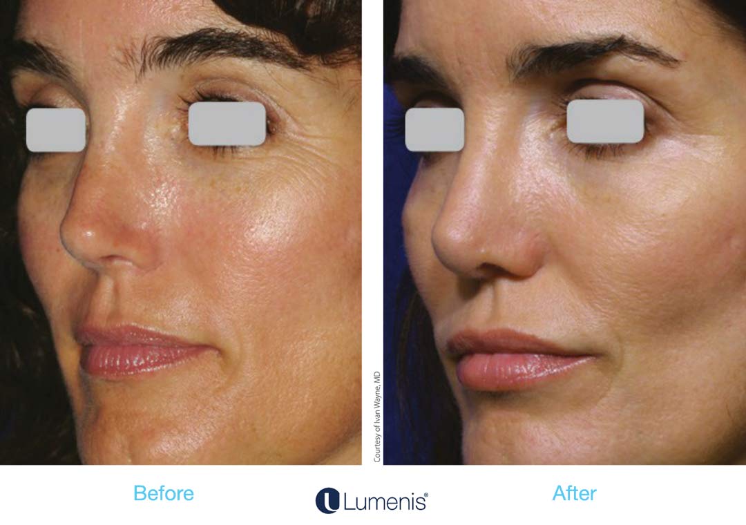 Skin texture improves with diminished pores and smoothed lumps and bumps, like sebaceous hyperplasias