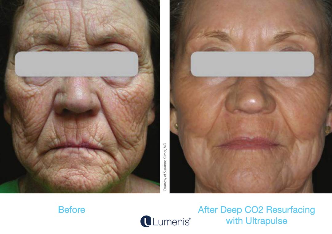 ActiveFX and DeepFX are amazing for wrinkles caused by volume/collagen loss, sun damage, and age.