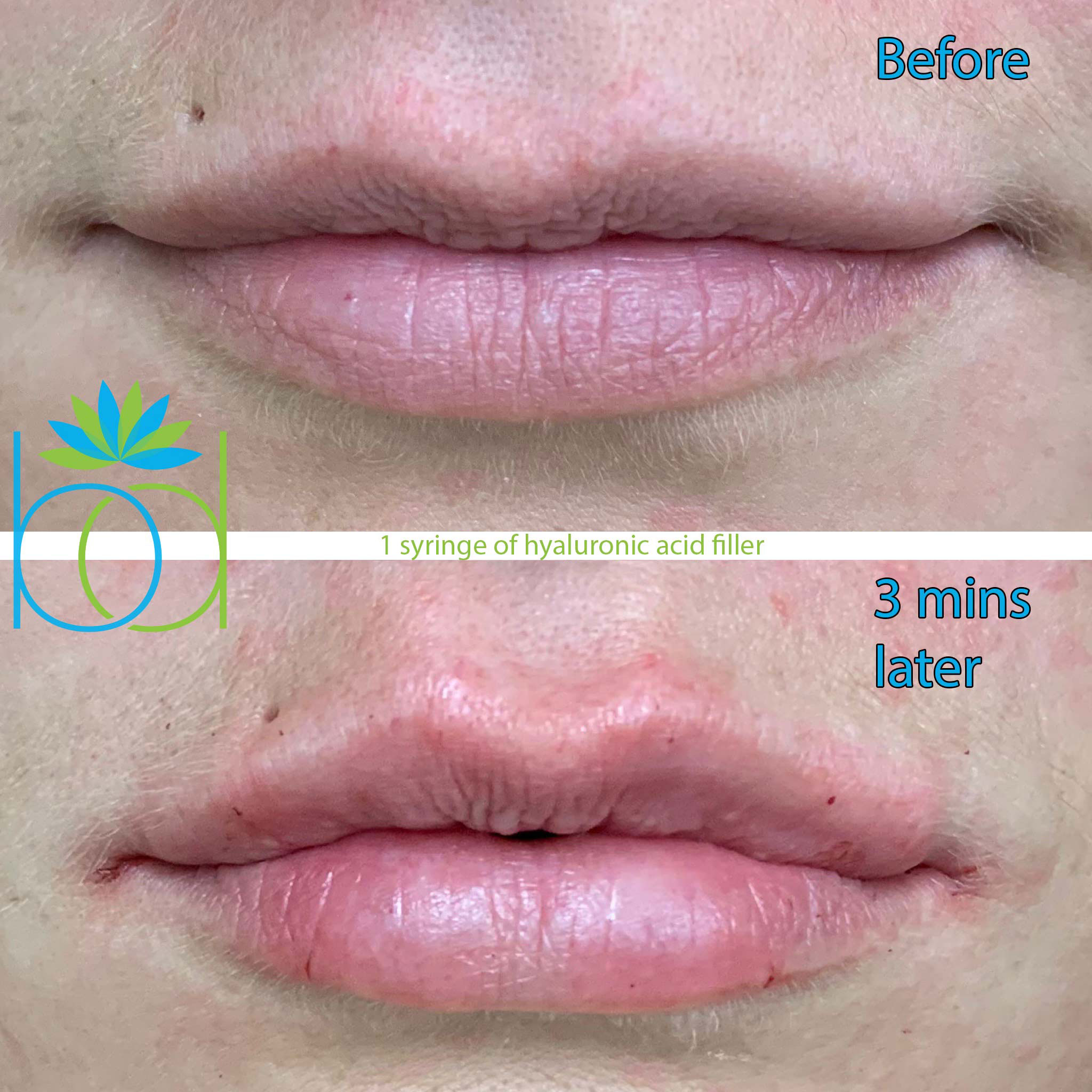 Before and After Hyaluronic Acid lip filler, Three minute transformation.