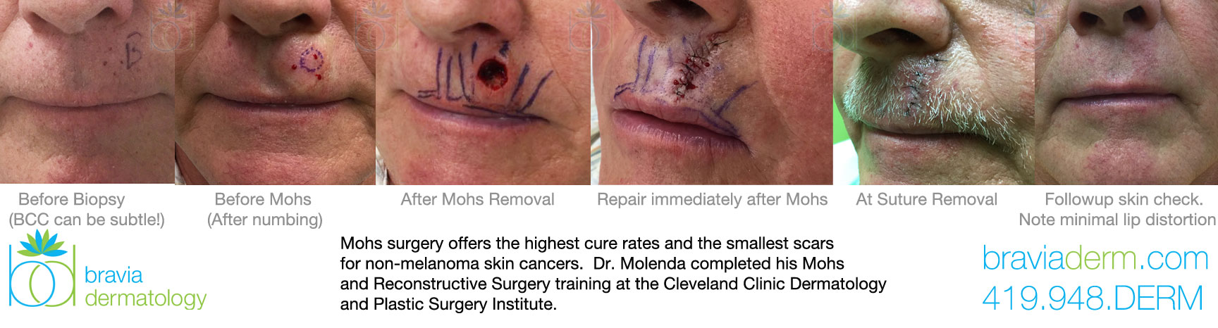 Mohs Surgery offers the highest cure rates and the smallest scars.