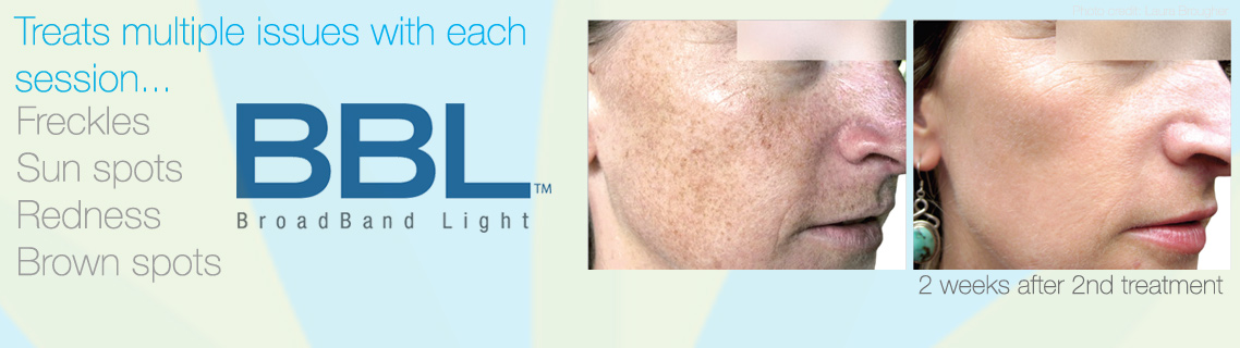 BBL at Bravia Dermatology treated freckles, sun spots and redness